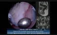 Histeroskopowa technika "roller ball " usunięcia mięśniaka podśluzówkowego dna macicy