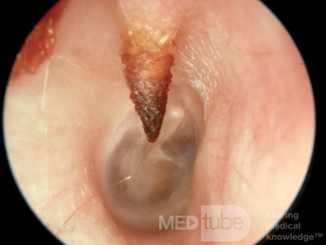 Nietypowa kostna wyrośl w przewodzie słuchowym zewnętrznym