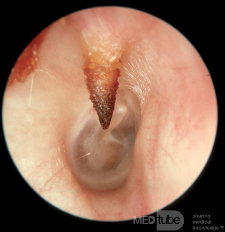 Nietypowa kostna wyrośl w przewodzie słuchowym zewnętrznym