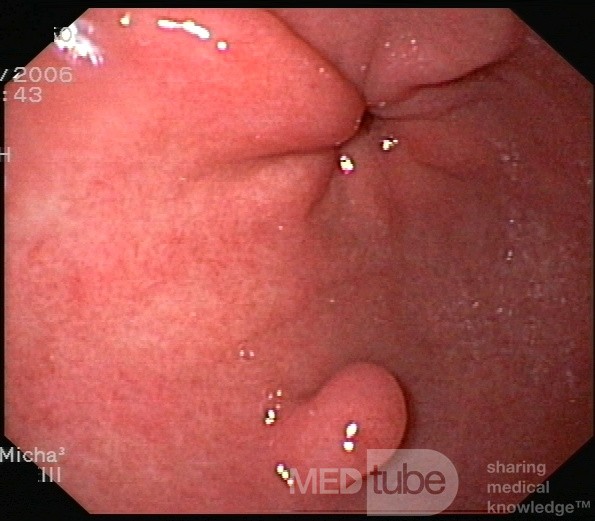 Polip hiperplastyczny wpustu żołądka