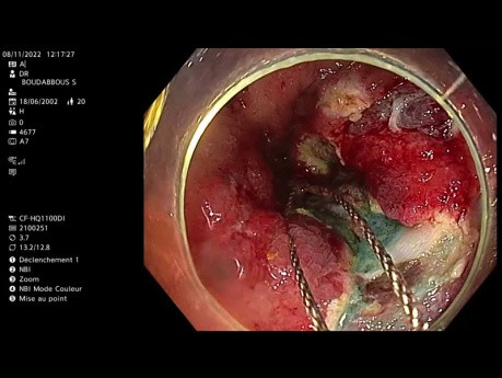 Endoskopowa resekcja błony śluzowej w okrężnicy wstępującej u pacjenta z chorobą Leśniowskiego-Crohna