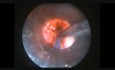 Endoskopowe wycięcie guza przezgłośniowego - część 2