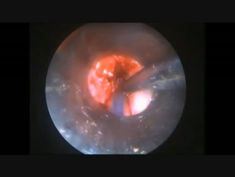 Endoskopowe wycięcie guza przezgłośniowego - część 2
