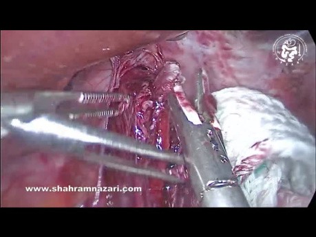 Operacyjne leczenie achalazji - mobilizacja lewego płata wątroby przez rozcięcie więzadła trójkątnego w celu odsłonięcia dolnej części przełyku
