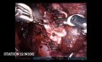 Robotowa segmentektomia prawego płuca S2+6