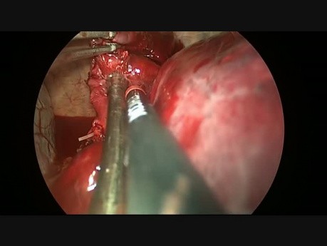 Resekcja dużej złożonej torbieli bronchogennej metodą VATS z dojścia uniportalnego