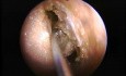 Endoskopowa etmoidektomia przednia
