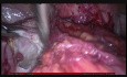 Całkowita laparoskopowa histerektomia, endometrioza w stopniu IV