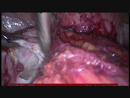 Całkowita laparoskopowa histerektomia, endometrioza w stopniu IV