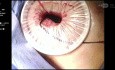 Pleuroskopia medyczna z biopsją opłucnej