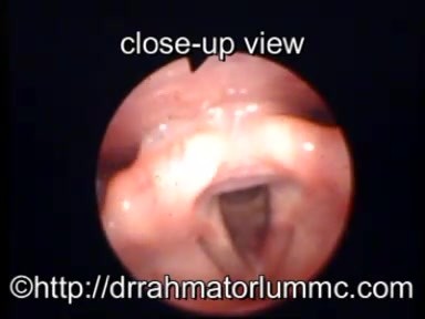 Widok laryngologiczny na szparę głośni po przezustnej chordektomii III typu