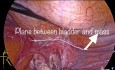 Laparoskopowe usunięcie mięśniaka więzadła szerokiego u kobiety po histerektomii