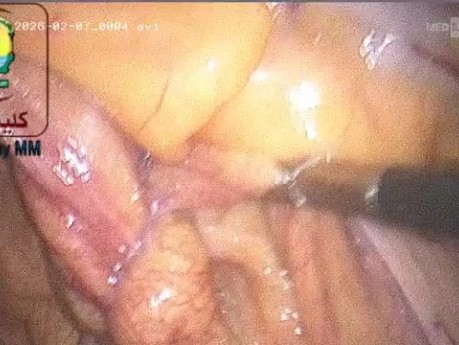 Trudności z usunięciem przemieszczonej wkładki wewnątrzmacicznej (IUD)