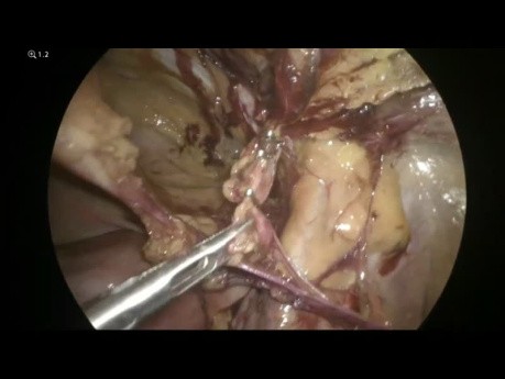 Laparoskopowa przepuklina udowa metodą TAPP - wyjaśnienie anatomii 