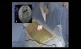 Endoskopowa dyscektomia kręgosłupa w odcinku lędźwiowym w przypadku stenozy bocznej i centralnej kanału kręgowego - dostęp interlaminarny