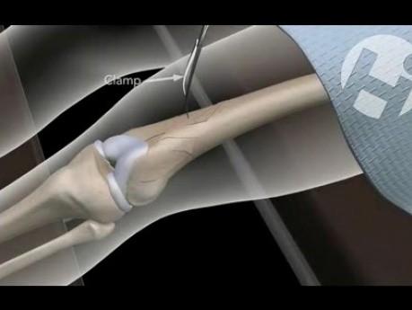 Złamanie kości udowej - stabilizacja wewnętrzna