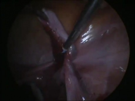 Uprzednio źle zdiagnozowana prawostronna torbiel więzadła szerokiego macicy - laparoskopia