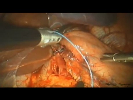 Od konwencjonalnej laparoskopii do miotomii Hellera z dostępu LESS z powodu achalazji
