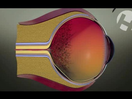 Witrektomia (Membrane Peeling i Scleral Buckle)