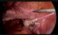Całkowita laparoskopowa histerektomia ze stentowaniem moczowodów