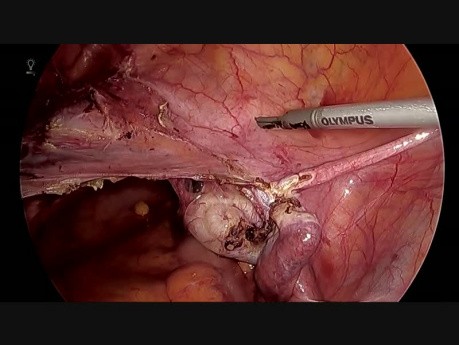 Całkowita laparoskopowa histerektomia ze stentowaniem moczowodów