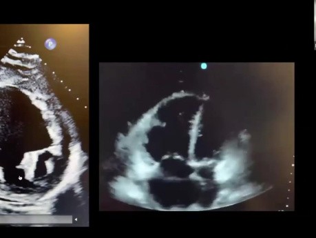 Hocus Pocus: Użycie POCUS dla oceny objętości i hemodynamiki oraz szybkiej diagnozy osobliwej