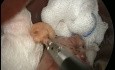 Krurorafia tylna metodą 3 dziurek od klucza z rękawową resekcją żołądka