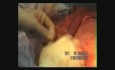 Operacja raka przełyku - ezofagogastrektomia