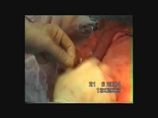 Operacja raka przełyku - ezofagogastrektomia