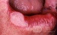 Plattenepithelkarzinom der Lippe