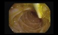 Endoskopowe usunięcie protezy PŻW
