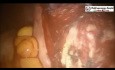 Zastosowanie chirurgii robotycznej w miomektomii