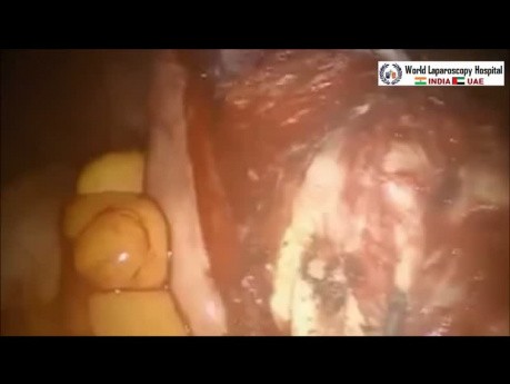 Zastosowanie chirurgii robotycznej w miomektomii