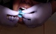 Implanty dentystyczne - wyciski na łyżce otwartej - instrukcja