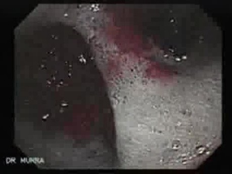 Rak włóknisty żołądka - endoskopia (14 z 47)