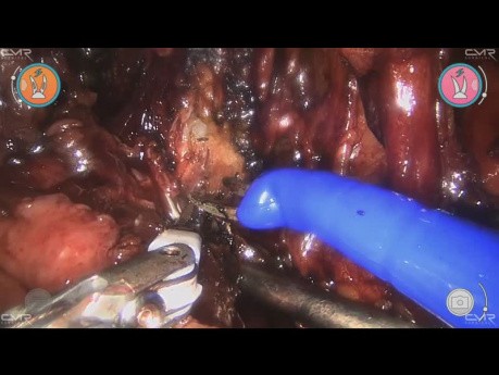 Dystalna ureterektomia i zespolenie moczowodowo-pęcherzowe przy użyciu robota Versius