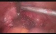 Usunięcie szyjki macicy po amputacji trzonu