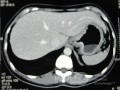 Obraz endoskopowy raka włóknistego żołądka obejmującego dno, trzon i część przedodźwiernikową (21 z 47)