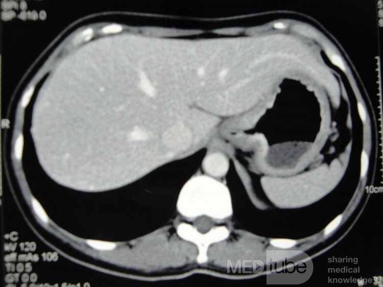 Obraz endoskopowy raka włóknistego żołądka obejmującego dno, trzon i część przedodźwiernikową (21 z 47)