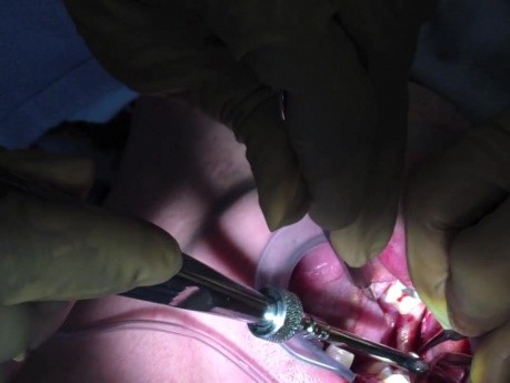 Przeszczep kości - nacięcia na gałęzi żuchwy