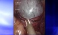 Cystektomia jajnika przez port SILS (jeden otwór)