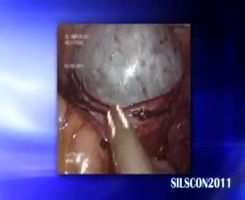 Cystektomia jajnika przez port SILS (jeden otwór)