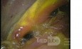 Stan po resekcji B2 - widok w endoskopii