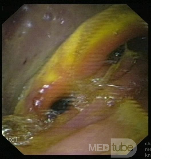 Stan po resekcji B2 - widok w endoskopii