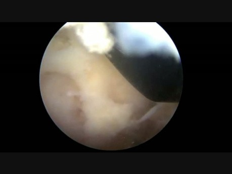 Operacja usunięcia przepukliny krążka międzykręgowego z powodu stenozy z dostępu przeciwstronnego 
