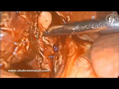 Laparoskopowa cholecystektomia z powodu zgorzelinowego zapalenia pęcherzyka żółciowego