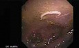 Trichurioza stwierdzona podczas wideokolonoskopii