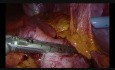 Obwodowa laparoskopowa resekcja żołądka