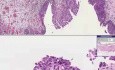 Rak komórek przejściowych in situ - histopatologia - pęcherz moczowy