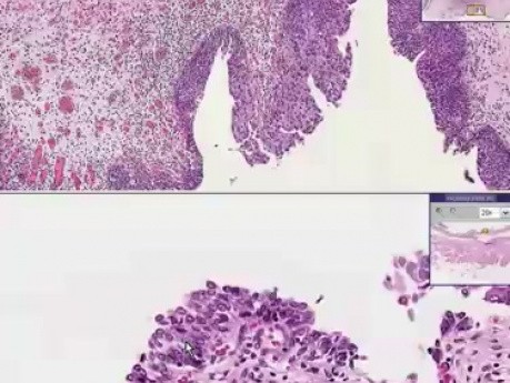 Rak komórek przejściowych in situ - histopatologia - pęcherz moczowy